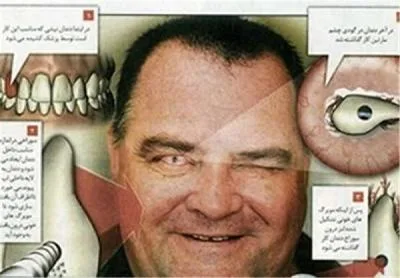 پیوند عجیب دندان به جای چشم!