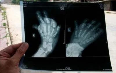 دختری که پاهایش شبیه دستانش است