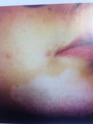 ويتيليگو (برص) از دكتر شهزاد شيرزاد متخصص و جراح بيماري هاي پوست و ليزر