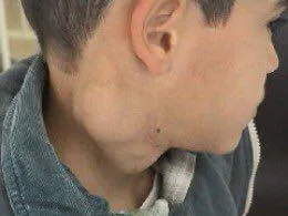 لنفوم