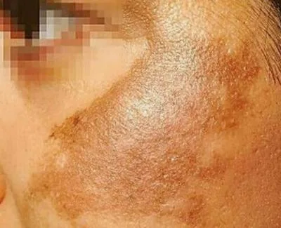 ملاسما ( کلوسما ، ماسک  حاملگی )