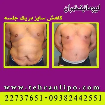 ابدومینوپلاستی