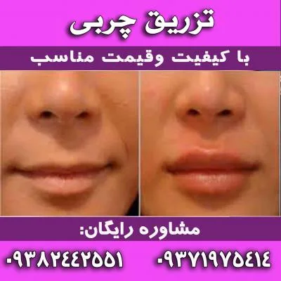 تزریق چربی