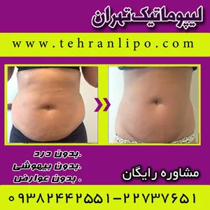 لیپوماتیک