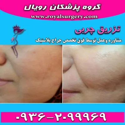 تزریق چربی