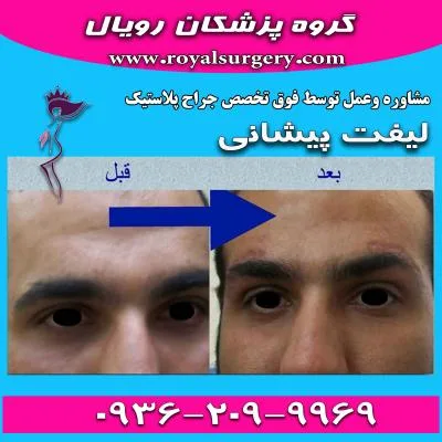 لیفت پیشانی