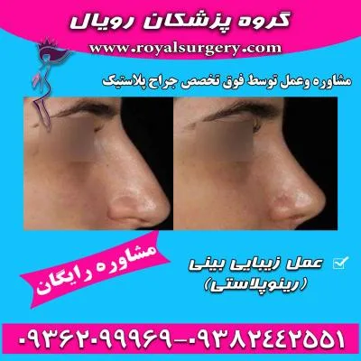 عمل بینی استخوانی