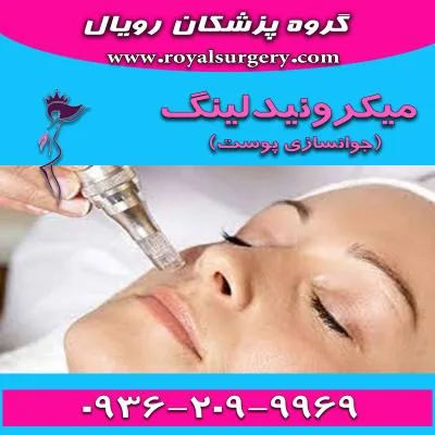 میکرونیدلینگ