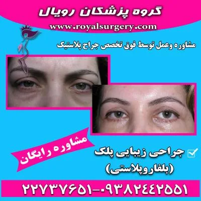 جراحی زیبایی پلک