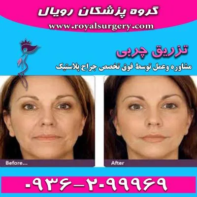 فیلم تزریق چربی