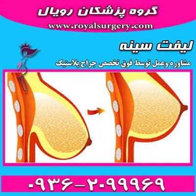 لیفت سینه