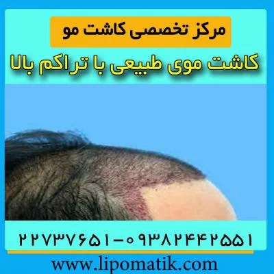 کاشت مو اقساطی