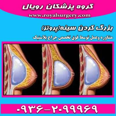 پروتز سینه