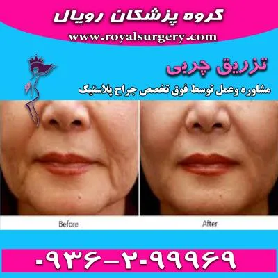 ماندگاری تزریق چربی