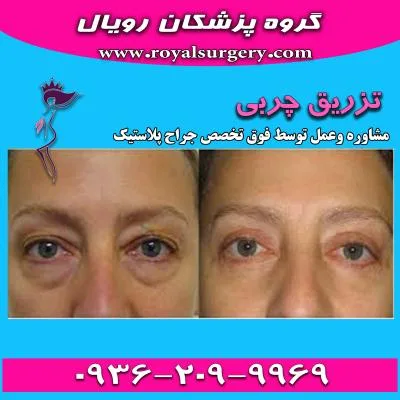 تزریق چربی به زیر چشم