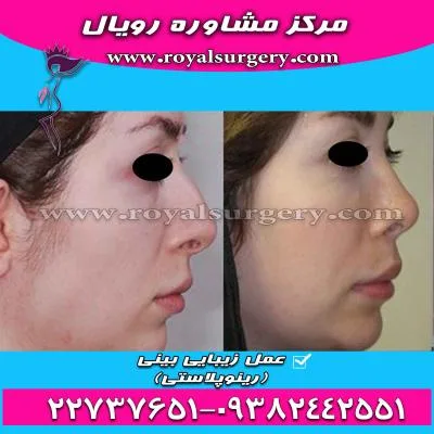 عمل بینی