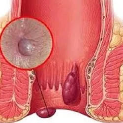 دلایل اصلی مبتلا شدن به بواسیر