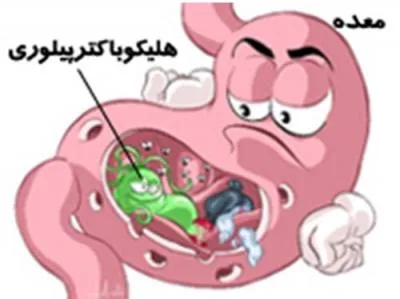 عفونت هليكو باكتر پيلوري