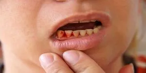 علت‌های شایع خونریزی لثه حین مسواک زدن