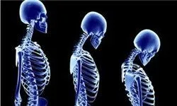 برای بهبود استخوان شکسته چه بخوریم؟