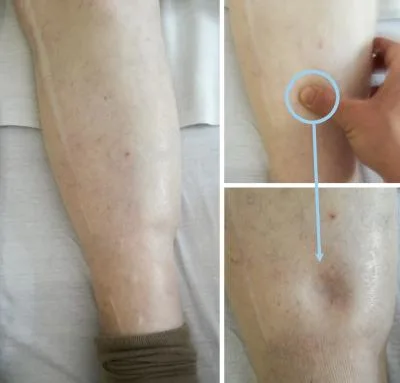ادم گوده گذار در اندام تحتانی