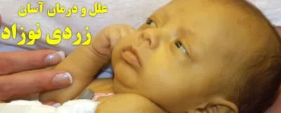 یرقان یا زردی