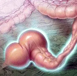 فکال ایمپکشن ( Fecal Impaction)