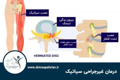 درمان قطعی سیاتیک بدون جراحی