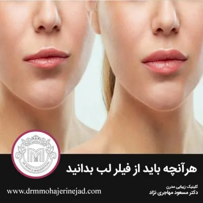 هرآنچه باید از فیلر لب بدانید