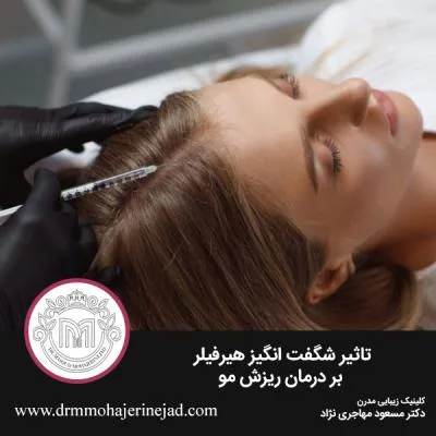 تاثیر شگفت انگیز هیرفیلر بر درمان ریزش مو