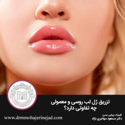 تزریق ژل لب روسی و معمولی چه تفاوتی دارد؟