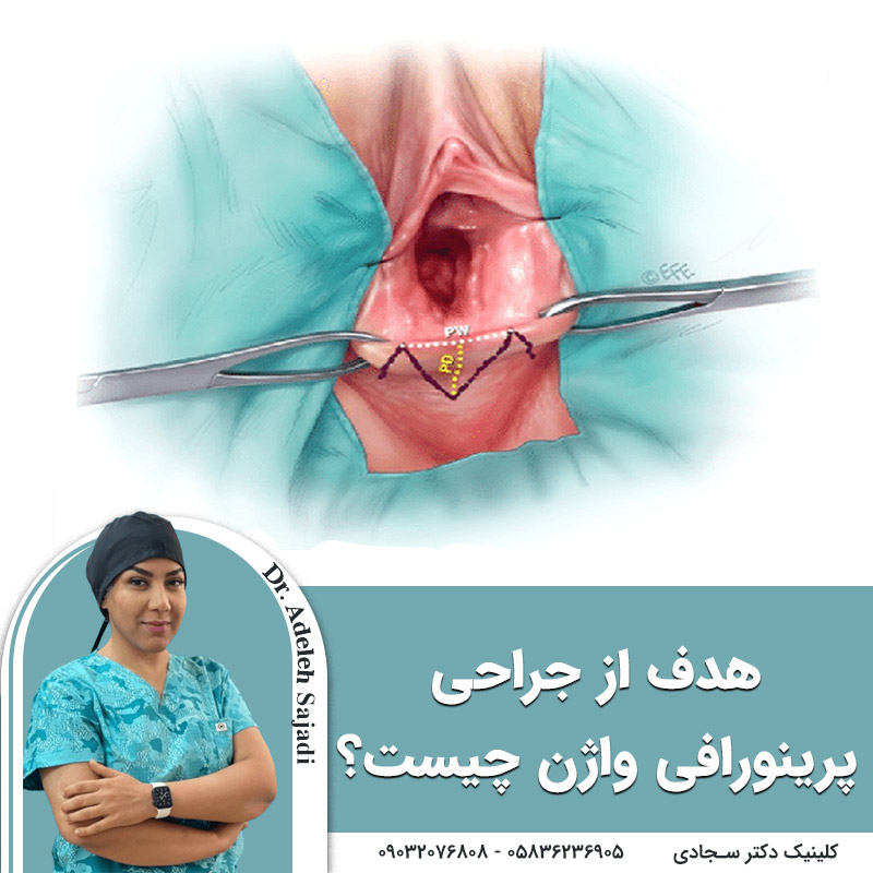  هدف از جراحی پرینورافی واژن چیست؟
