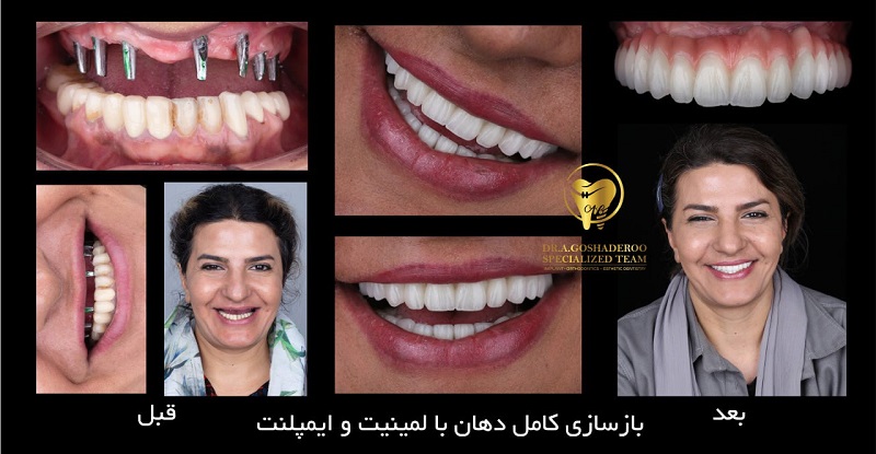  روکش سرامیکی دندان: راه‌حلی زیبا و بادوام برای ترمیم دندان