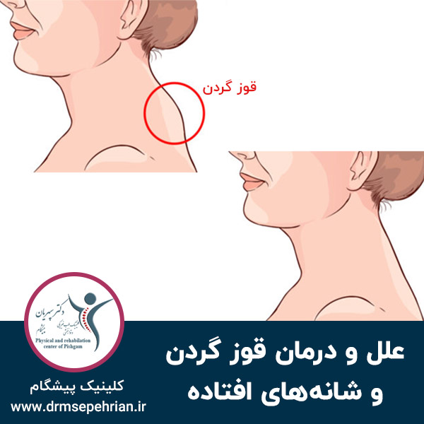  علل و درمان قوز گردن و شانه‌های افتاده