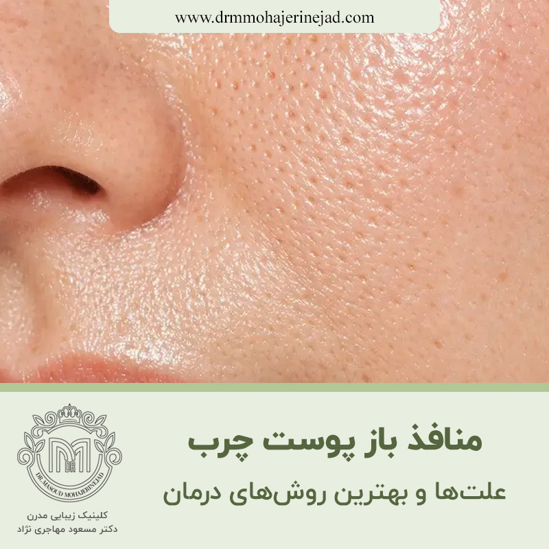  منافذ باز پوست چرب؛ علت‌ها و بهترین روش‌های درمان