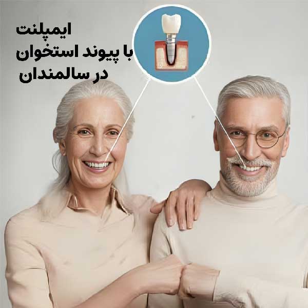  ایمپلنت و کاشت دندان با وجود پوکی استخوان در سنین بالا