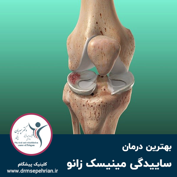  بهترین درمان ساییدگی مینیسک زانو
