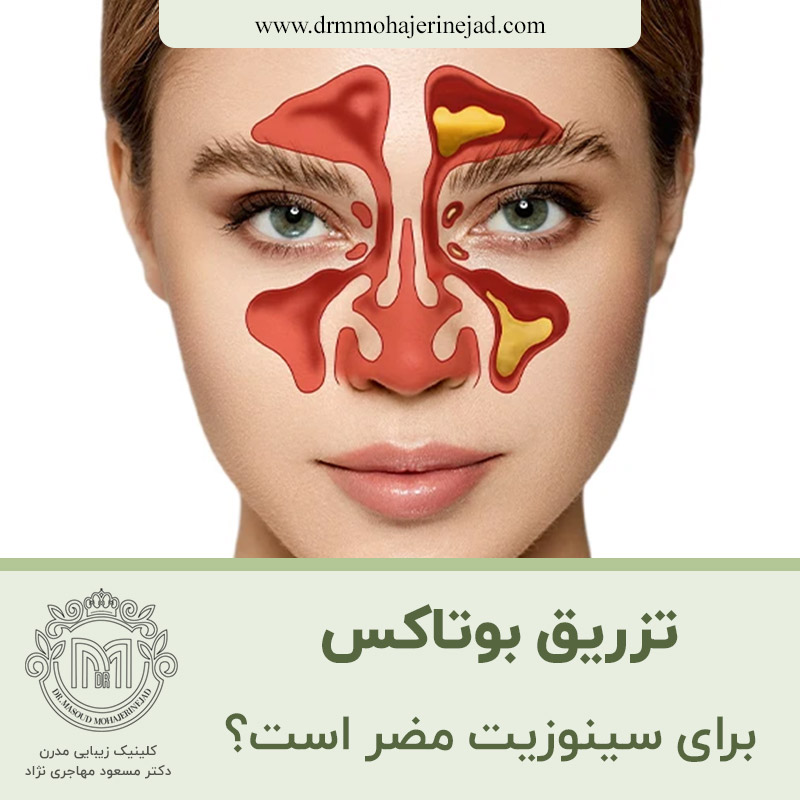  آیا بوتاکس برای سینوزیت مضر است؟