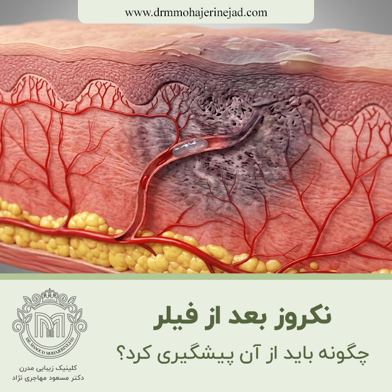  چگونه باید از نکروز بعد از فیلر پیشگیری کرد؟