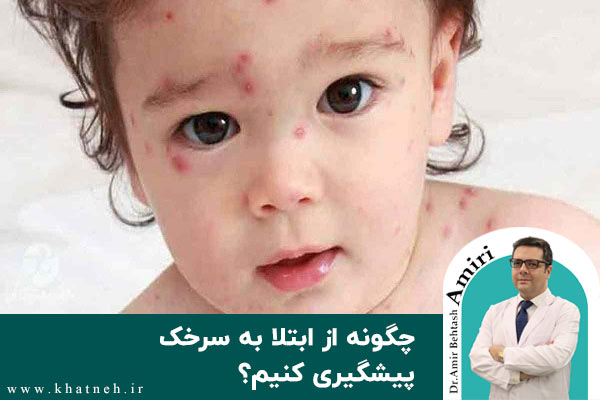  چگونه از ابتلا به سرخک پیشگیری کنیم؟