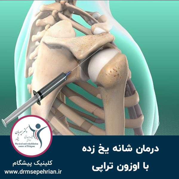  درمان شانه یخ زده با اوزون تراپی