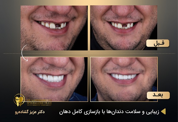  بهترین متخصص ایمپلنت در تهران _ دکتر عزیز گشاده رو