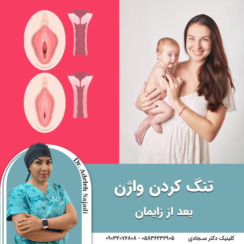  تنگ کردن واژن بعد از زایمان