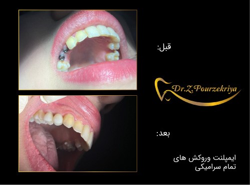  درمان ریشه دندان (عصب کشی): راهی برای نجات دندان آسیب دیده