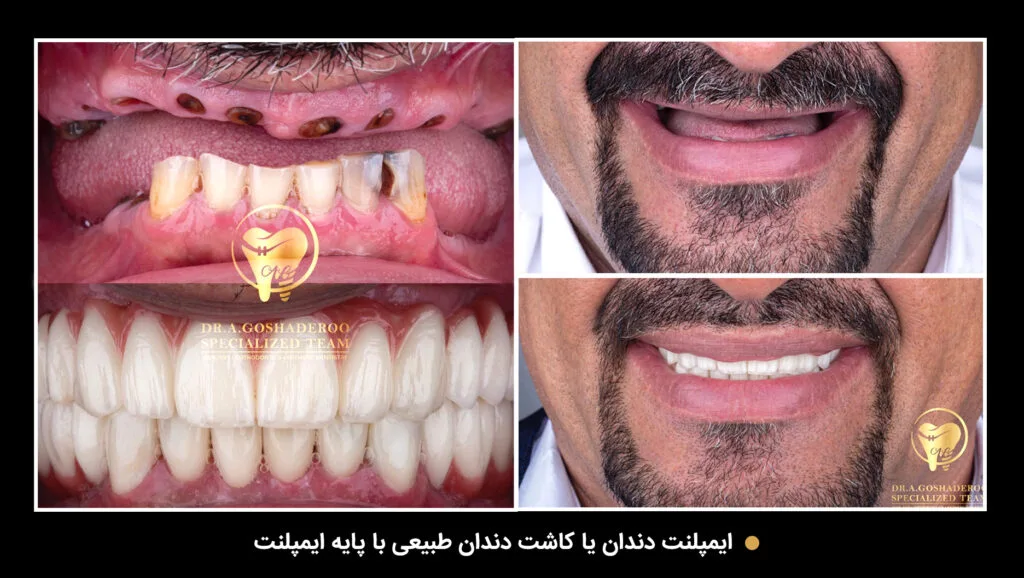 ایمپلنت یک دقیقه‌ای؛ واقعیت یا تبلیغ فریبنده !!