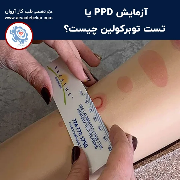 آزمایش PPD یا تست توبرکولین چیست؟