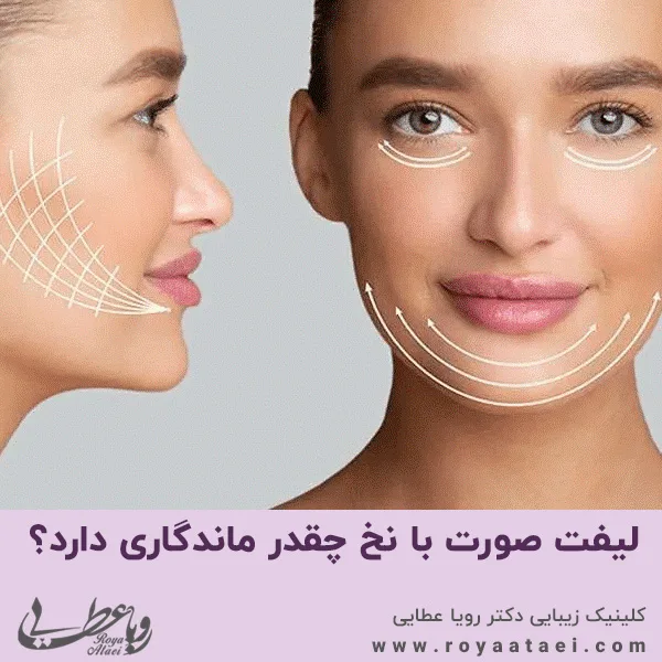 لیفت صورت با نخ چقدر ماندگاری دارد؟