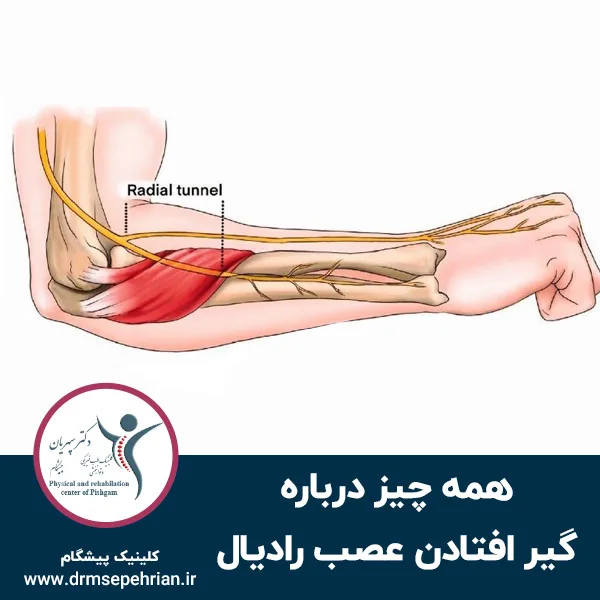 همه چیز درباره از گیر افتادن عصب رادیال
