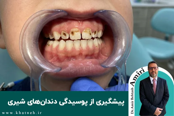 چگونه از پوسیدگی دندان های شیری پیشگیری کنیم؟