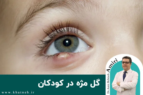 آنچه باید از گل مژه در کودکان بدانید